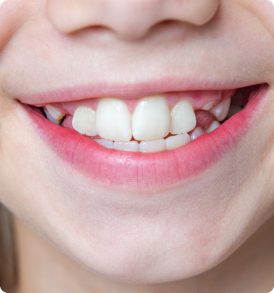 Orthodontie interceptive2
